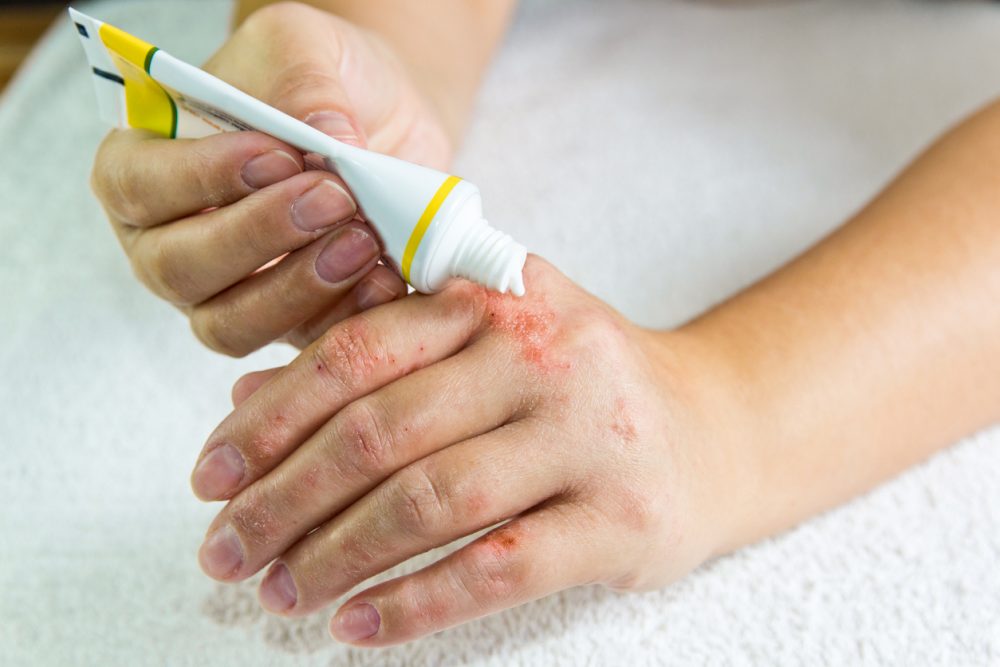applying-cream-on-eczema-hands-e1568034241694.jpg