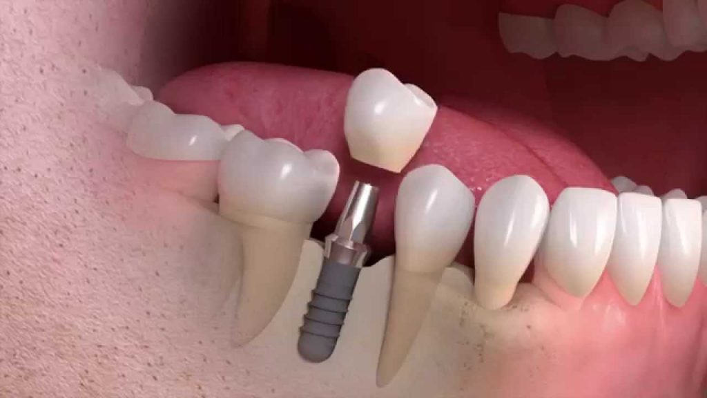 what-is-dental-implants-1024x576.jpg