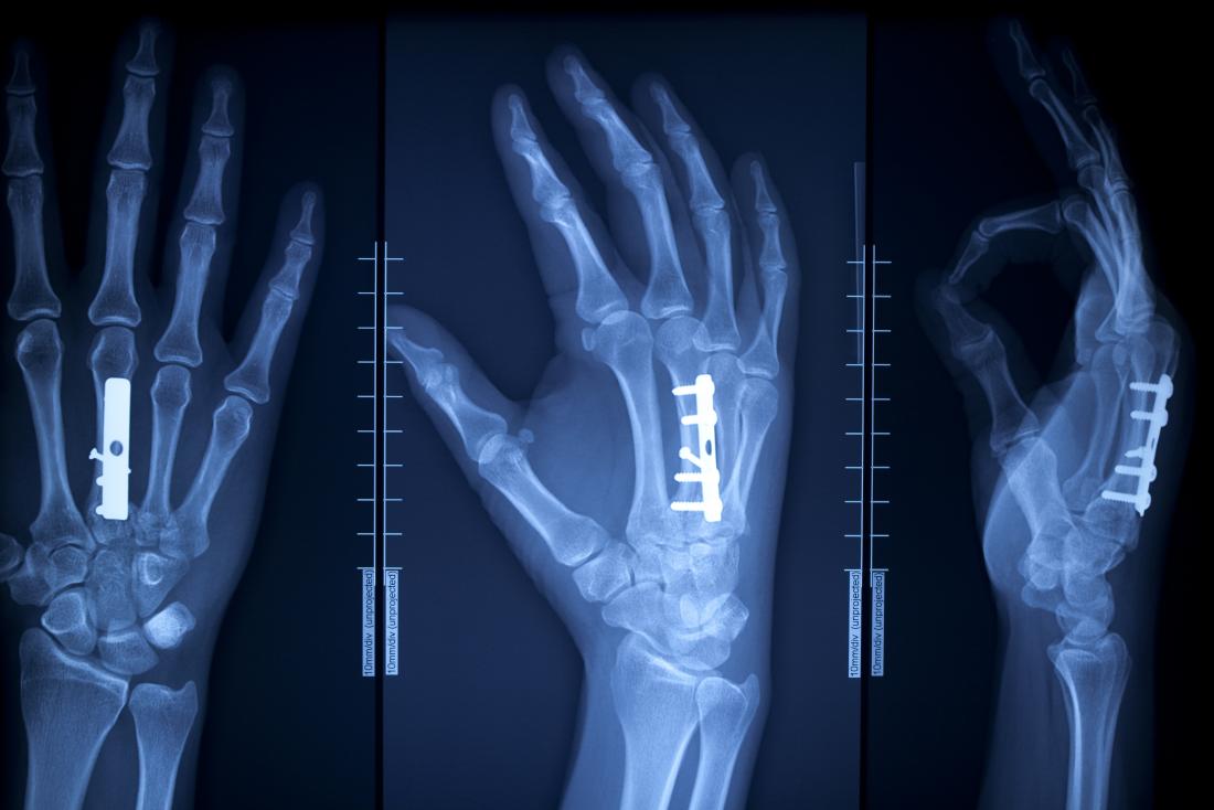 x-ray-of-hand-with-surgical-pins-and-screws-in-the-bone.jpg