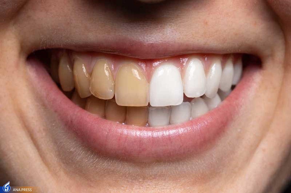 جرم‌گیری دندان‌ها باعث تضعیف لثه نمی‌شود