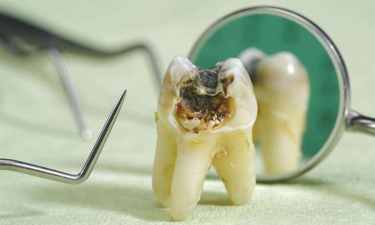 پیشگیری از پوسیدگی دندان با کامپوزیت دندانی ایران‌ساخت