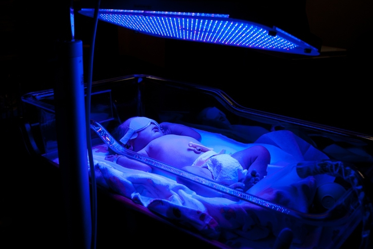 نوردرمانی تنها روش مجاز برای درمان زردی نوزاد است