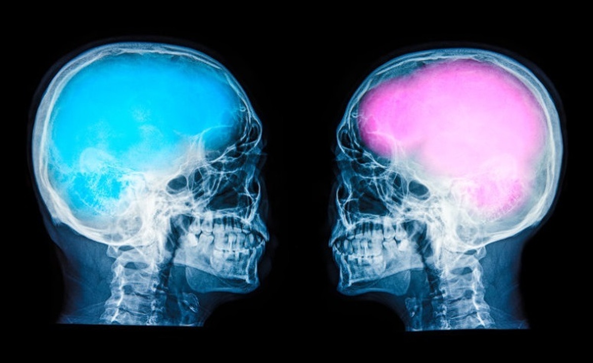 هوش مصنوعی با اسکن مغز جنسیت‌ را تشخیص می‌دهد