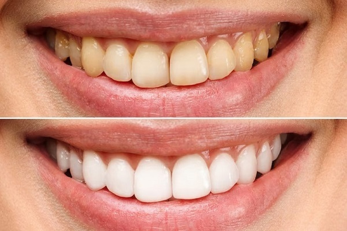 کامپوزیت دندان در کلینیک دندانپزشکی عرشیان