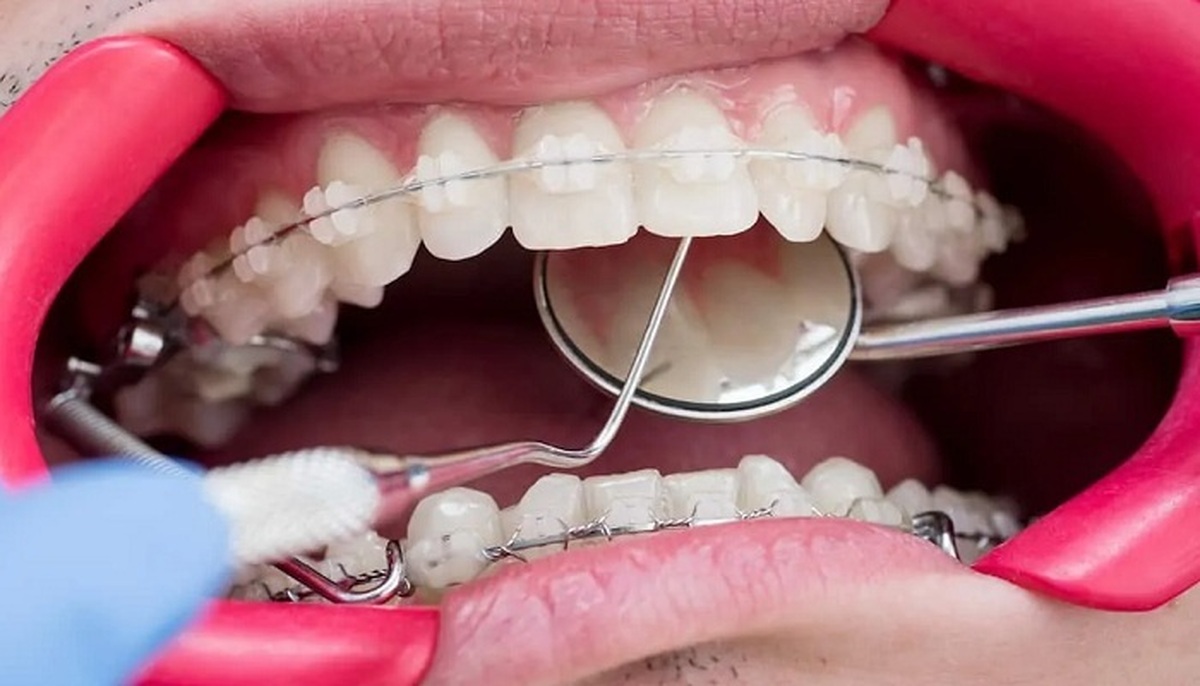 ساخت آلیاژی کاربردی در صنعت دندانپزشکی