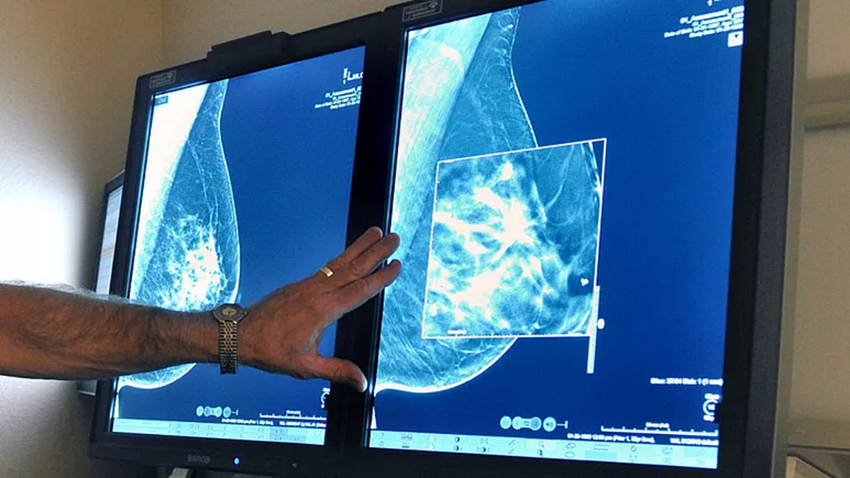 هوش مصنوعی در غربالگری سرطان «به‌خوبی رادیولوژیست‌ها» عمل می‌کند