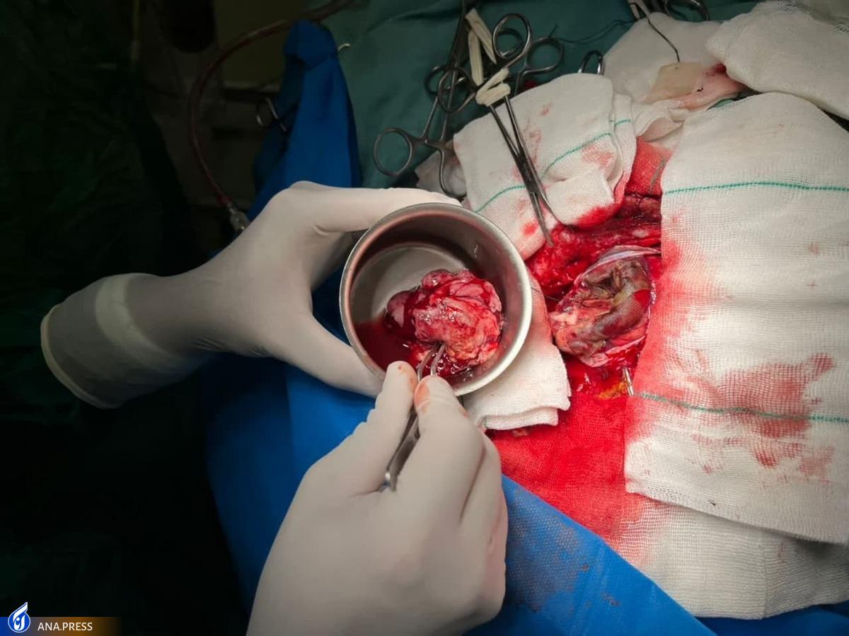 انجام نخستین عمل جراحی باز مغز در بیمارستان شاه‌ولی یزد